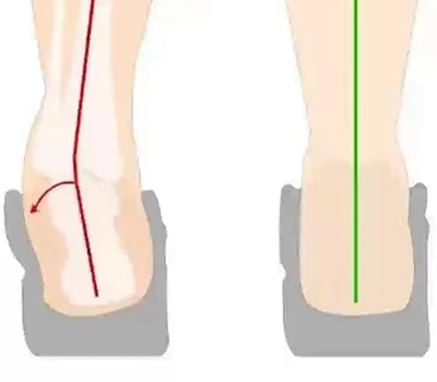 Bedömning av hälvändning och hälinversion: klinisk utvärdering, praktiska tillämpningar och komme...