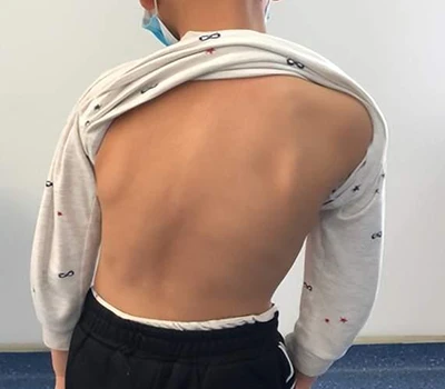 Skoliosscreening och hantering: Hur Xianku 3D Body Scanner hjälper kiropraktorer
