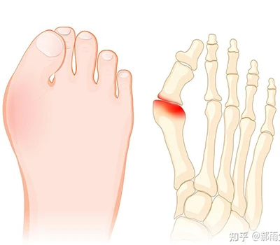 Hallux Valgus: En komplett vetenskapsguide