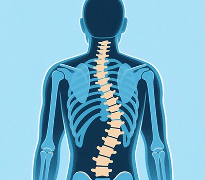 Scolios: Xianku 3D Body Scanner, 3D+AI, Scoliosis Prevention and Correction