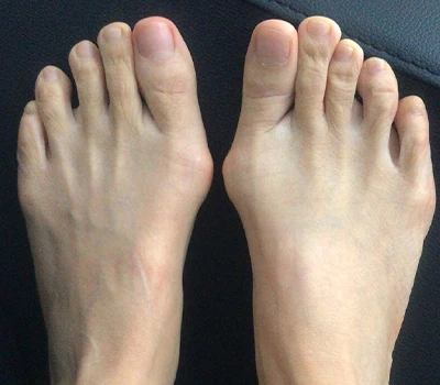 Hallux Valgus -mätningen: Varför 3D -skannrar överträffar kliniker och sjukhus