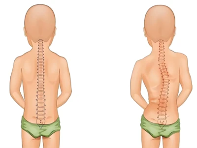 Ny metod för skoliosscreening: AI & 3D Digital Spine