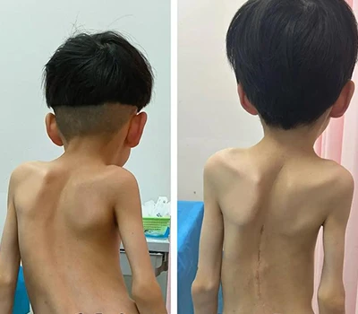 Spinal Health: Rollen för 3D-kroppsskanningsteknik i skoliosbedömning och marknadstransformation