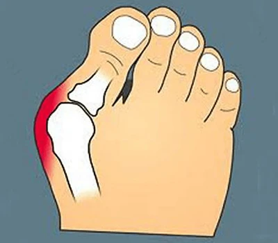 Transforming Bunion Care: Integrering av precisionsskanning för förbättrad anpassning, patienteng...